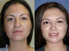 Case 3269 - Woman treated with Rhinoplasty