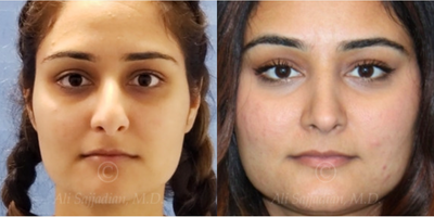 Case 3275 - woman treated with Rhinoplasty