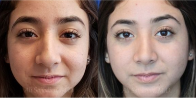 Case 3276 - woman treated with Rhinoplasty