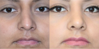 Case 3277 - woman treated with Rhinoplasty