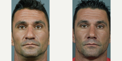 Case 3278 - Man treated with Rhinoplasty