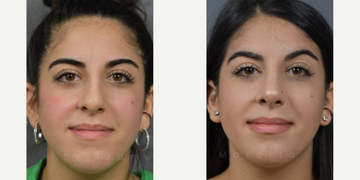 Case 3279 - Woman treated with Rhinoplasty