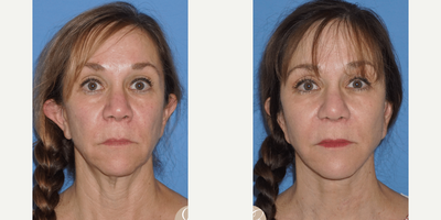 Case 3281 - 55-64 year old woman treated with Rhinoplasty
