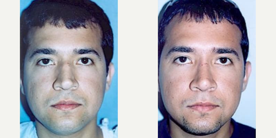 Case 3282 - Man treated with Rhinoplasty