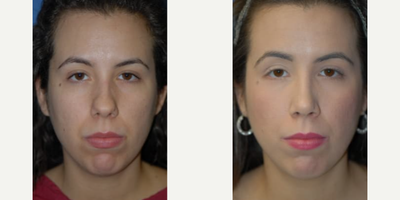Case 3283 - Woman treated with Rhinoplasty