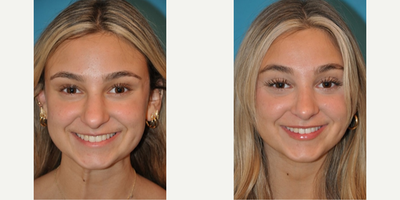 Case 3284 - Woman treated with Rhinoplasty