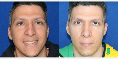 Case 3285 - Woman treated with Rhinoplasty