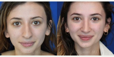 Case 3286 - Woman treated with Rhinoplasty