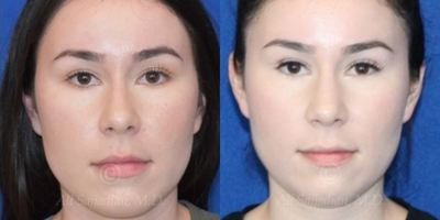 Case 3287 - Woman treated with Rhinoplasty