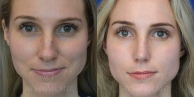 Case 3288 - Woman treated with Rhinoplasty