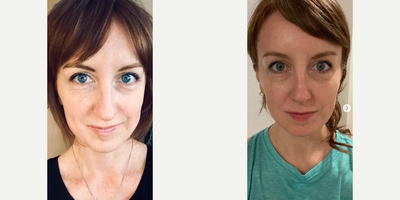 Case 3289 - Woman treated with Rhinoplasty