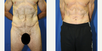 Case 329 - 45-54 year old man treated with Tummy Tuck