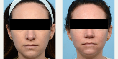 Case 3291 - 35-44 year old woman treated with Rhinoplasty