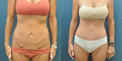 Case 33 - Woman treated with Tummy Tuck