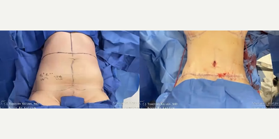 Case 330 - 25-34 year old woman treated with Tummy Tuck