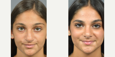 Case 3303 - Woman treated with Rhinoplasty