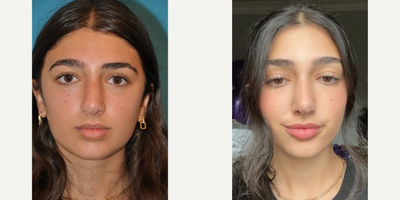 Case 3304 - Woman treated with Rhinoplasty