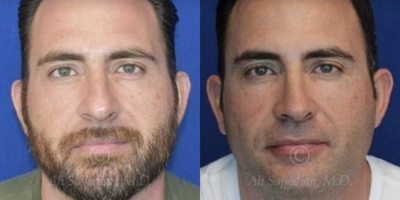 Case 3305 - Man treated with Rhinoplasty