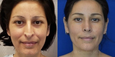 Case 3306 - Woman treated with Rhinoplasty