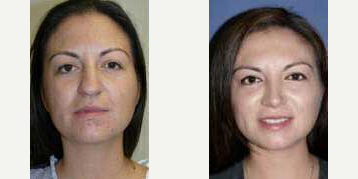 Case 3307 - Woman treated with Rhinoplasty