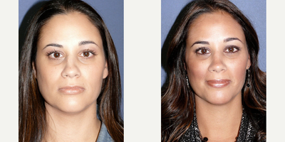 Case 3308 - Woman treated with Rhinoplasty