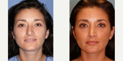 Case 3309 - Woman treated with Rhinoplasty