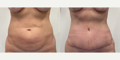 Case 331 - 45-54 year old woman treated with Tummy Tuck