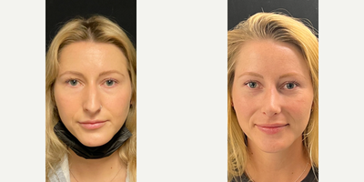 Case 3310 - Woman treated with Rhinoplasty