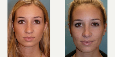 Case 3311 - Woman treated with Rhinoplasty