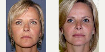 Case 3312 - Woman treated with Rhinoplasty