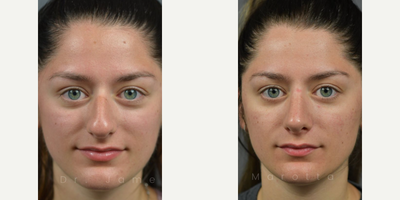 Case 3313 - Woman treated with Rhinoplasty