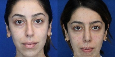 Case 3317 - Woman treated with Rhinoplasty