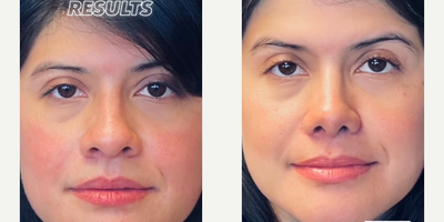 Case 3319 - Woman treated with Rhinoplasty