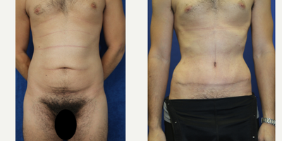 Case 332 - 35-44 year old man treated with Tummy Tuck