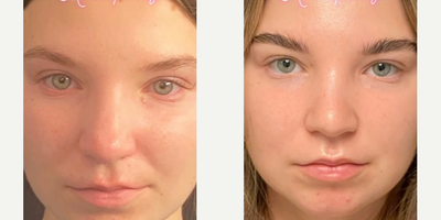 Case 3320 - Woman treated with Rhinoplasty