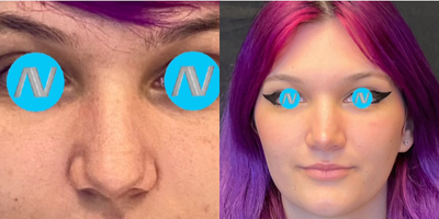 Case 3321 - Woman treated with Rhinoplasty