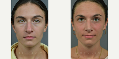 Case 3322 - Woman treated with Rhinoplasty