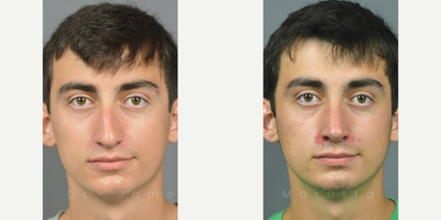 Case 3323 - Man treated with Rhinoplasty, Septoplasty