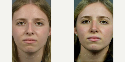Case 3324 - Woman treated with Rhinoplasty