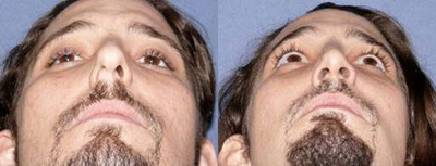 Case 3325 - Man treated with Rhinoplasty