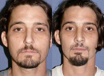 Case 3326 - Man treated with Rhinoplasty