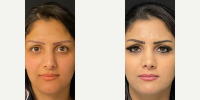 Case 3328 - Woman treated with Rhinoplasty