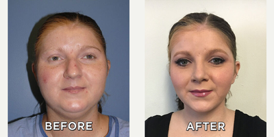 Case 3329 - Woman treated with Rhinoplasty