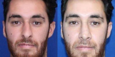 Case 3330 - Woman treated with Rhinoplasty