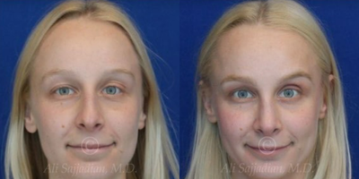 Case 3331 - Woman treated with Rhinoplasty