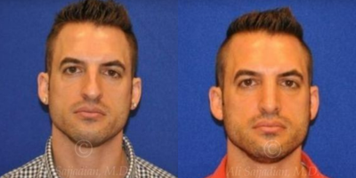 Case 3332 - Woman treated with Rhinoplasty