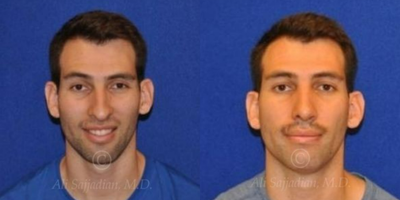 Case 3333 - Woman treated with Rhinoplasty