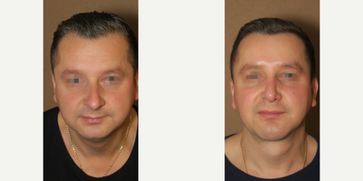 Case 3335 - Man treated with Rhinoplasty