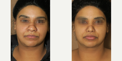 Case 3336 - Woman treated with Rhinoplasty
