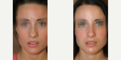 Case 3337 - Woman treated with Rhinoplasty